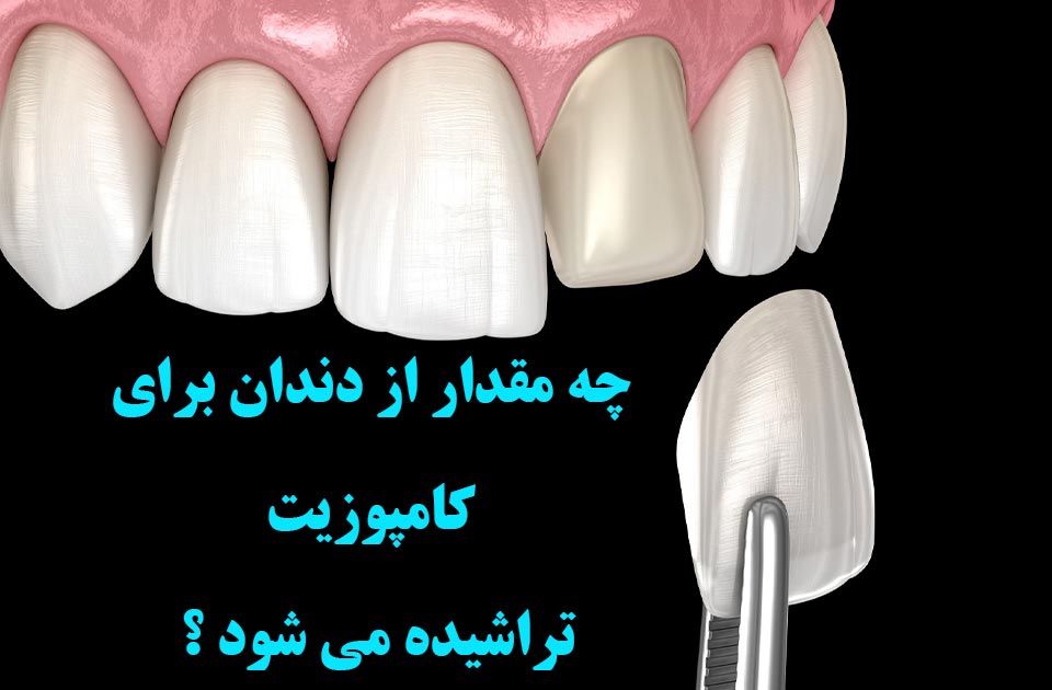 چه مقدار از دندان برای کامپوزیت تراش داده می شود ؟