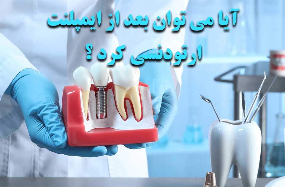 آیا بعد از ایمپلنت می توان ارتودنسی کرد ؟