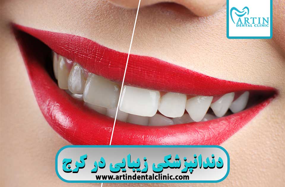 دندانپزشکی زیبایی در کرج !