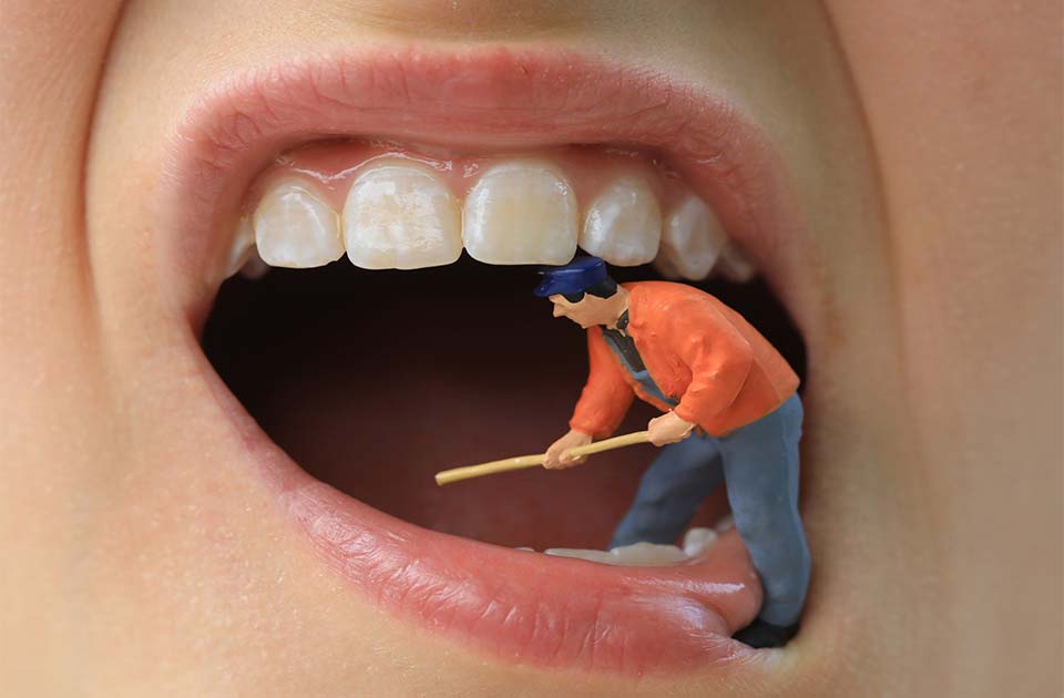 دندان نهفته چیست ؟ (همه چیز درباره دندان نهفته )