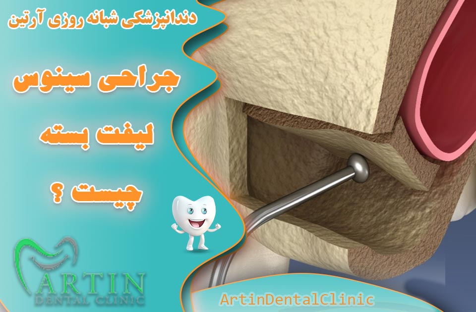 جراحی سینوس لیفت بسته چیست ؟