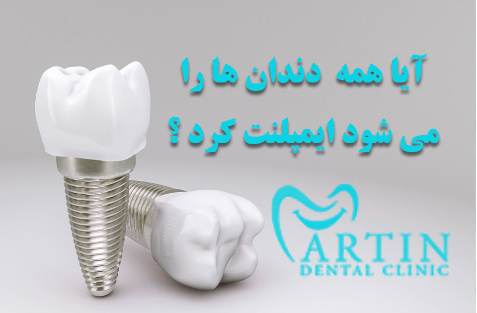آیا همه دندان ها را می شود ایمپلنت کرد ؟