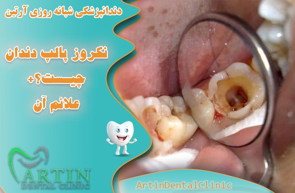 نکروز پالپ دندان چیست ؟ + علائم آن