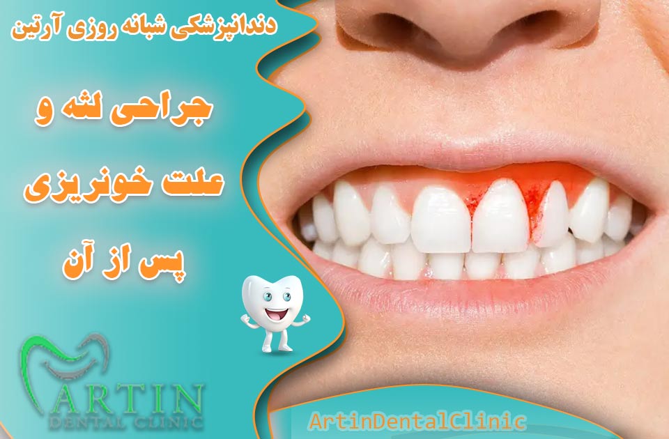 جراحی لثه و علت خونریزی پس از آن