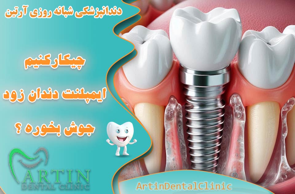 چیکار کنیم ایمپلنت دندان زود جوش بخوره ؟