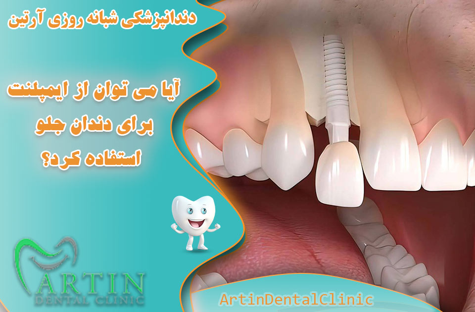 آیا می توان از ایمپلنت دندانی برای دندان های جلو استفاده کرد ؟