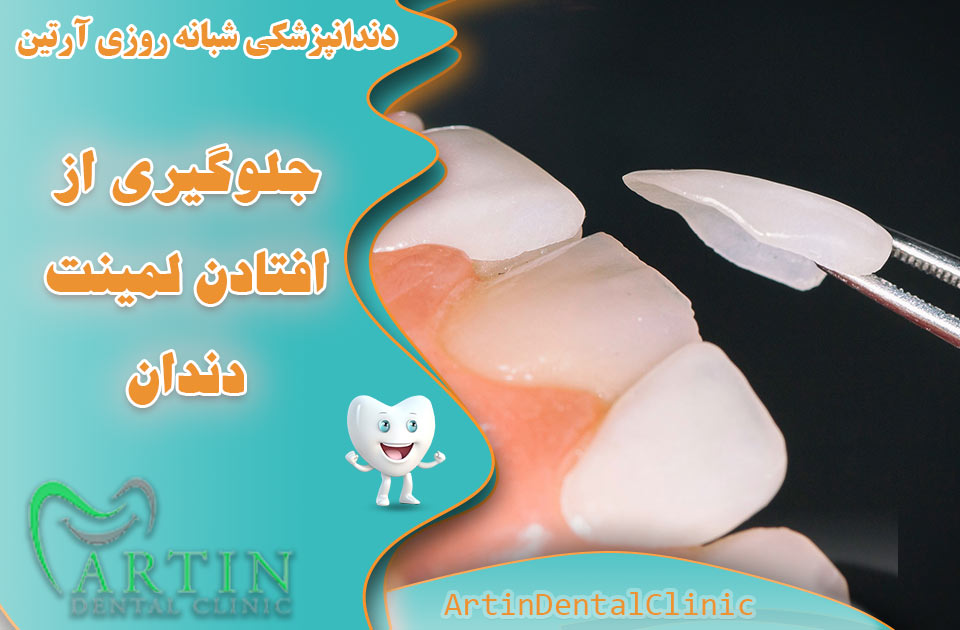 جلوگیری از افتادن لمینت دندان