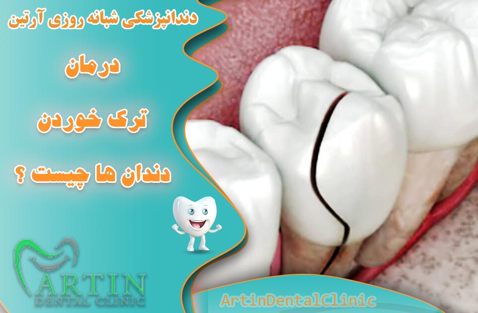 درمان ترک خوردن دندان ها چیست ؟