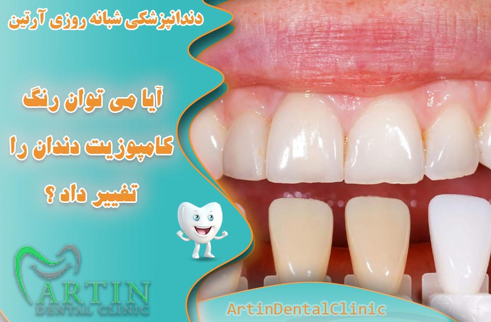 آیا می توان رنگ کامپوزیت دندان را تغییر داد ؟