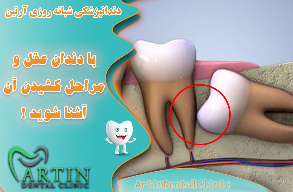 با دندان عقل و مراحل کشیدن آن آشنا شوید!