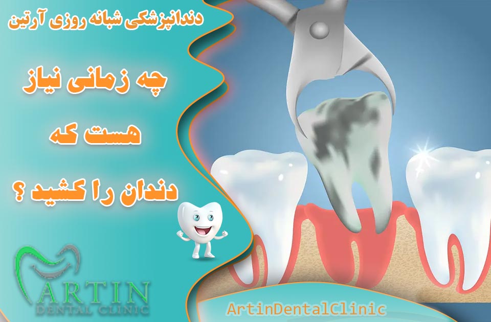 چه زمانی نیاز هست که دندان را کشید ؟