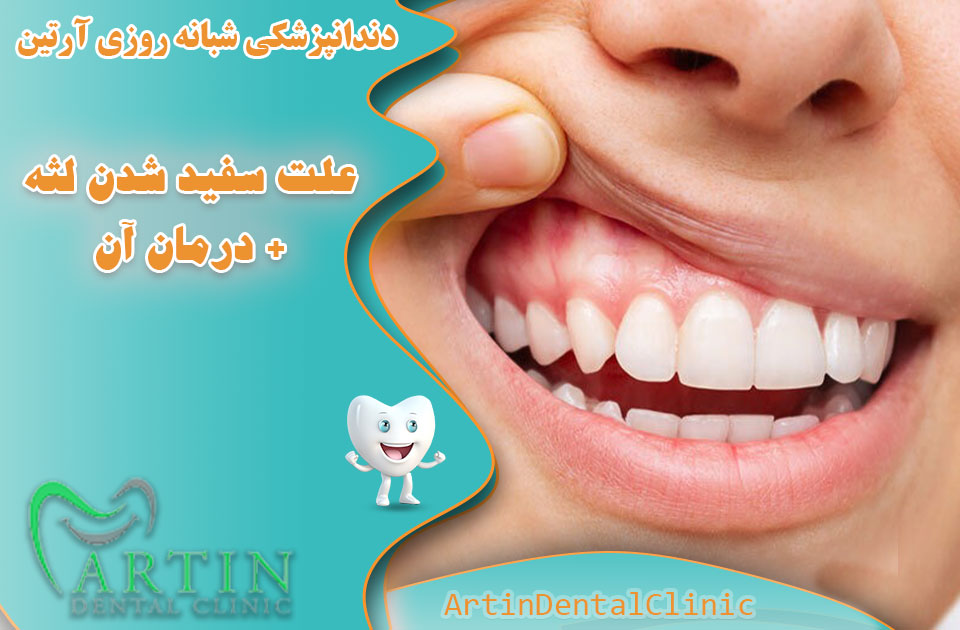 علت سفید شدن لثه + درمان آن