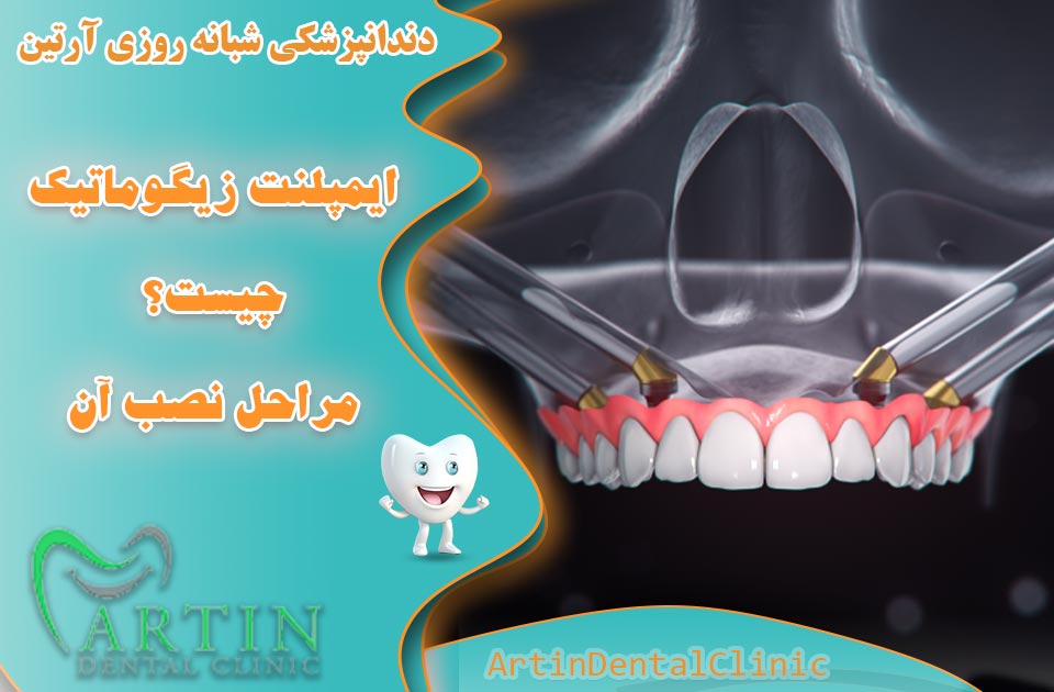 ایمپلنت زیگوماتیک چیست ؟ فرآیند نصب، مزایا و نکات مهم