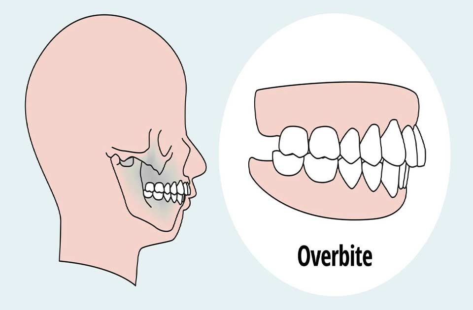 اوربایت چیست ؟ ( تفاوت های اوربایت با اورجت )
