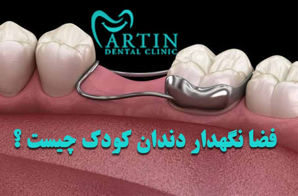 فضا نگهدار دندان کودک چیست ؟