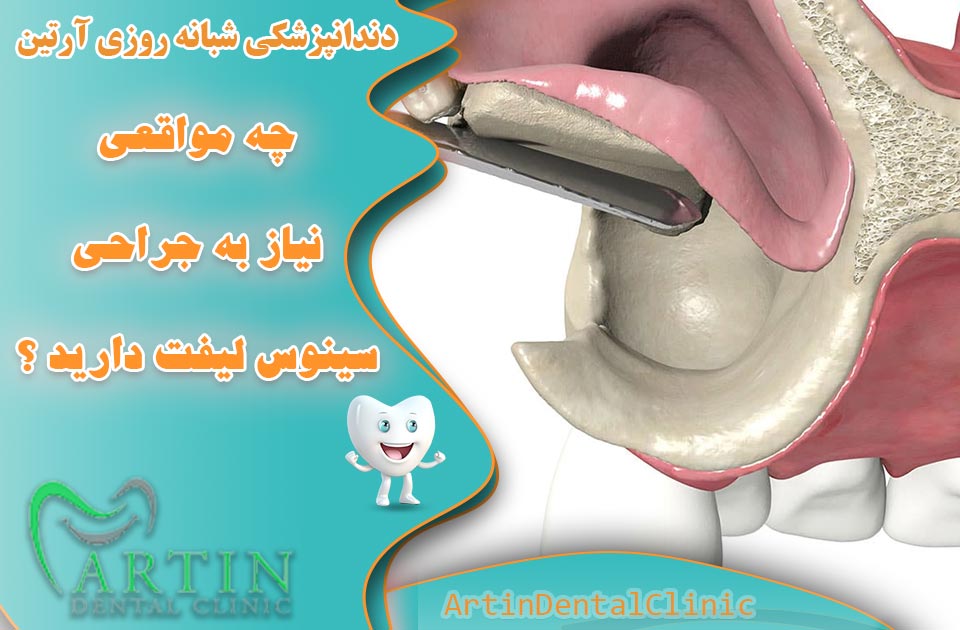 چه مواقعی نیاز به جراحی سینوس لیفت دارید ؟