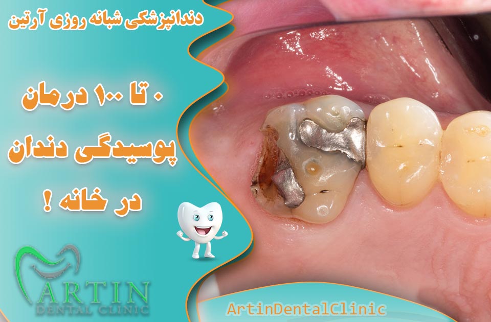 درمان 0 تا 100 پوسیدگی دندان در خانه