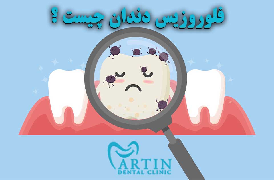 فلوروزیس دندان چیست ؟