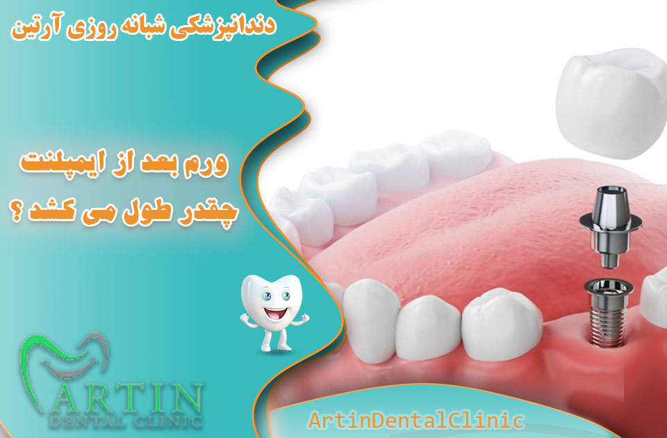 ورم بعد از ایمپلنت دندان چقدر طول می کشد ؟