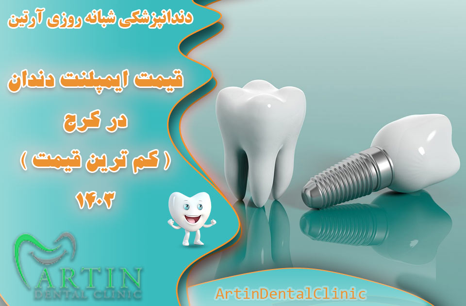 قیمت ایمپلنت دندان در کرج ( کمترین قیمت 1403 )