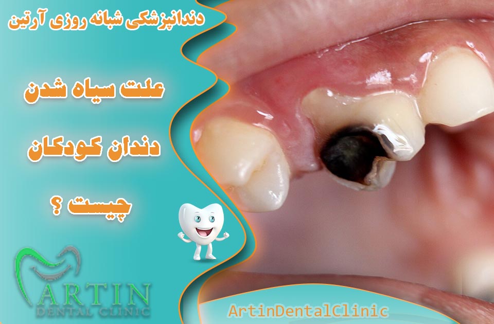 علت سیاه شدن دندان در کودکان چیست ؟