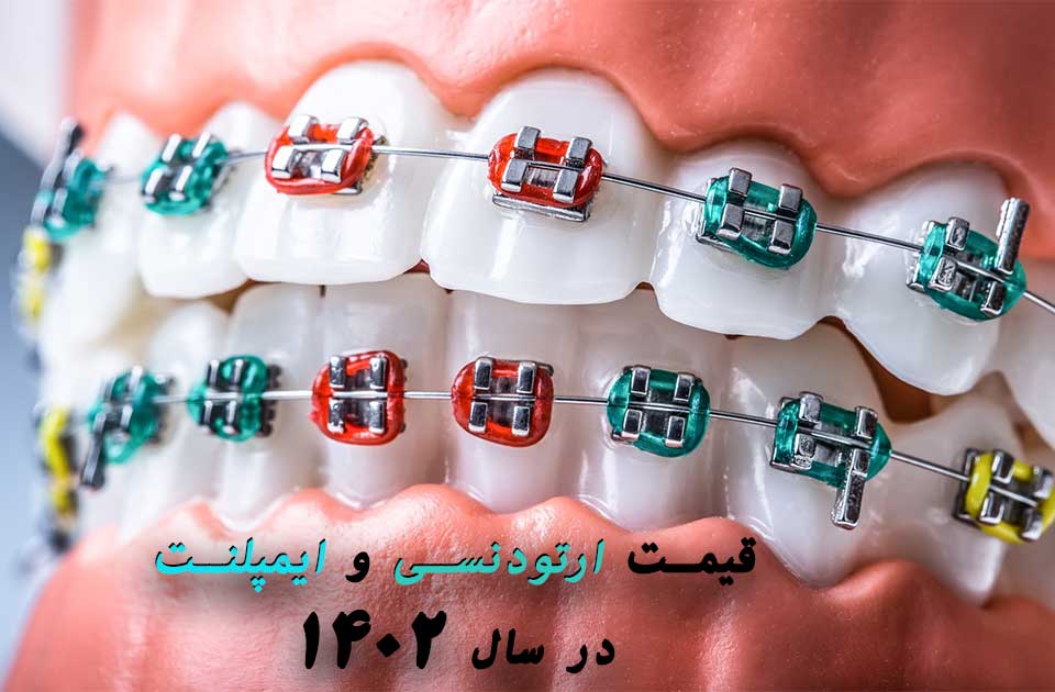 قیمت ارتودنسی دندان و ایمپلنت در سال 1403 در کرج