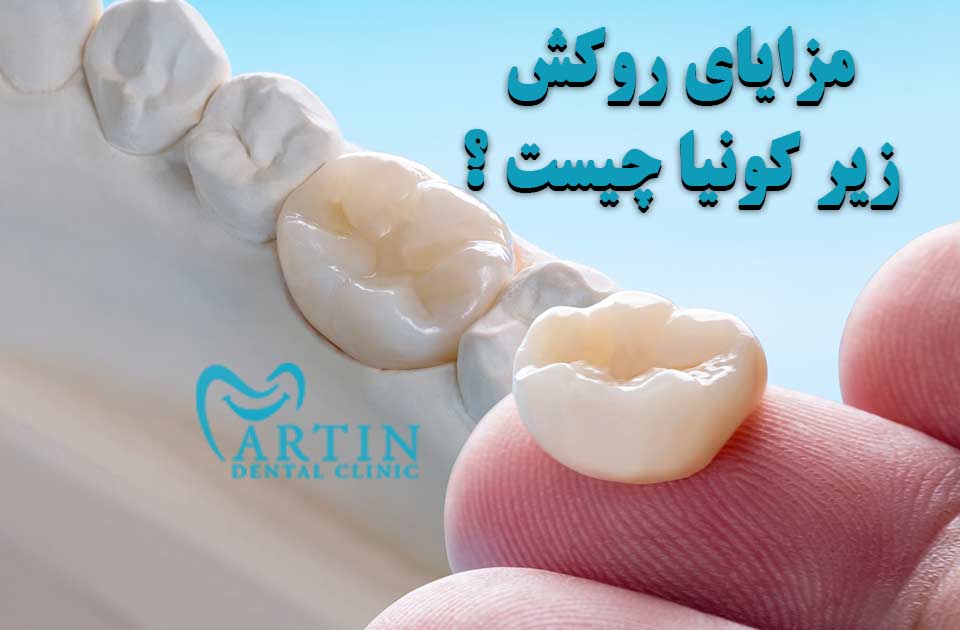 مزایای روکش زیرکونیا چیست ؟