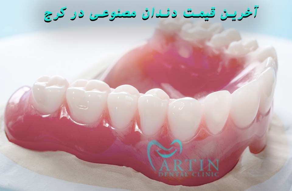آخرین قیمت دندان مصنوعی ارزان در کرج !