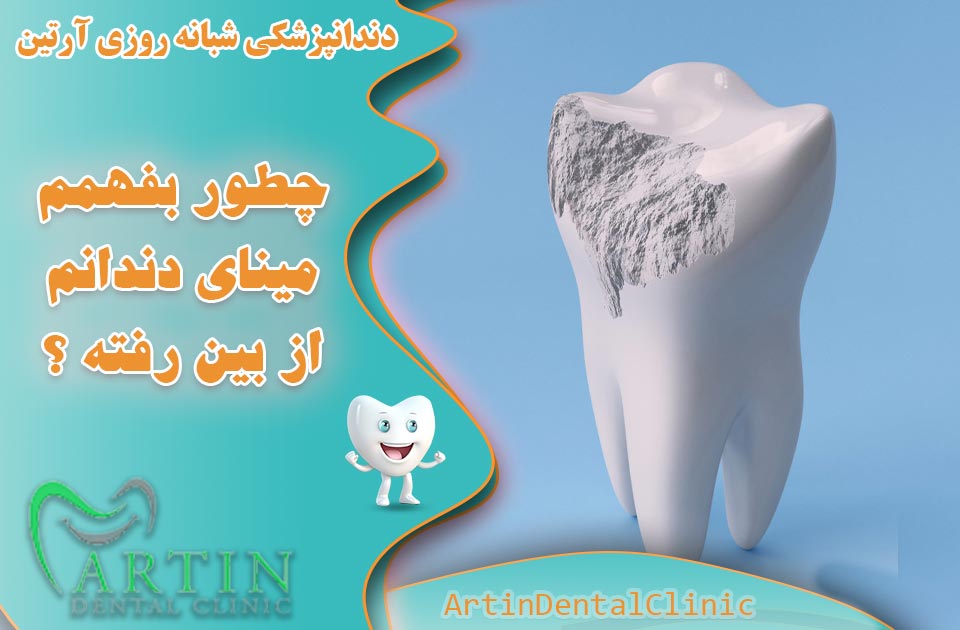 چطور بفهمم مینای دندانم از بین رفته ؟