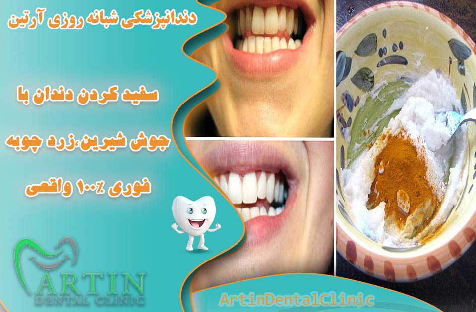 سفید کردن دندان با ( زردچوبه و جوش شیرین ) فوری و 100% واقعی