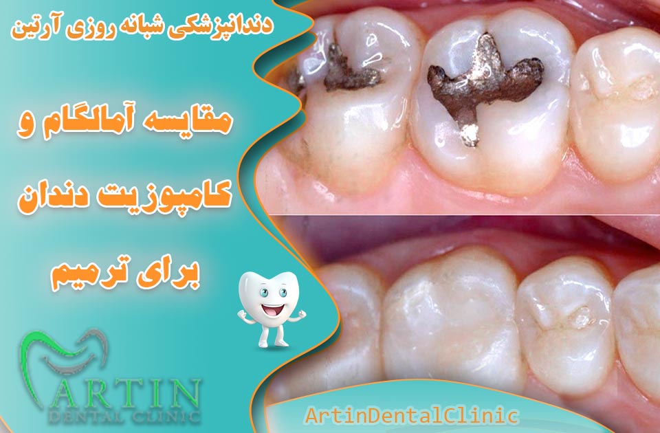 مقایسه کامپوزیت و آمالگام برای ترمیم دندان