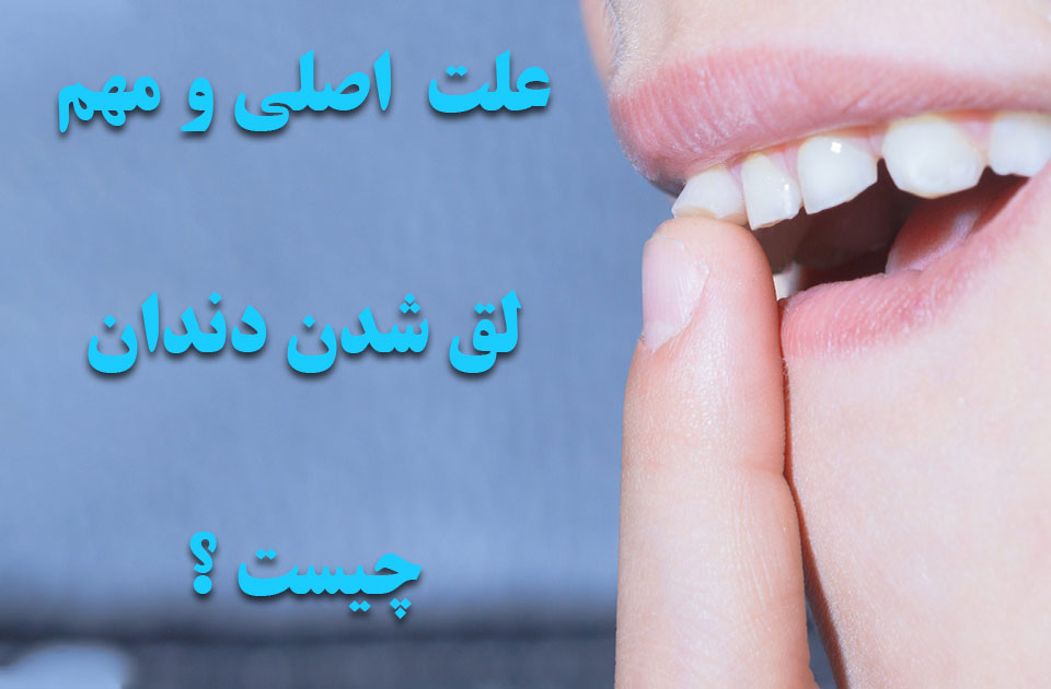6 علت اصلی و مهم لق شدن دندان دائمی چیست ؟