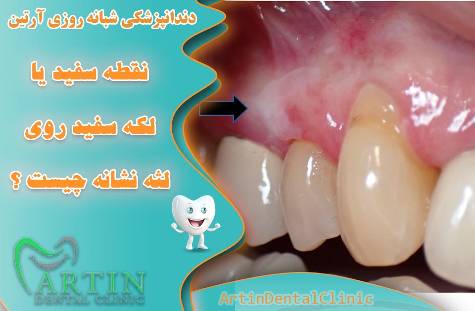 نقطه سفید یا لکه روی لثه نشانه چیست ؟