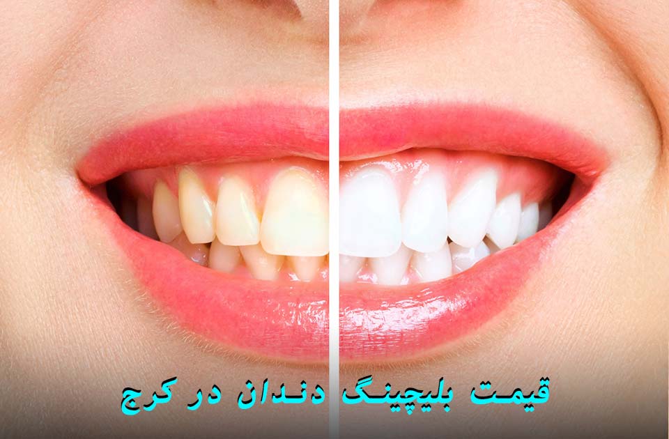 قیمت بلیچینگ دندان در کرج سال 1403 !