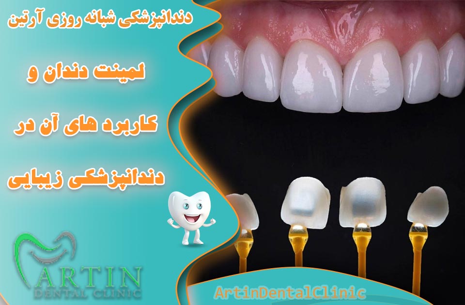 لمینت دندان و کاربردهای آن در دندانپزشکی زیبایی