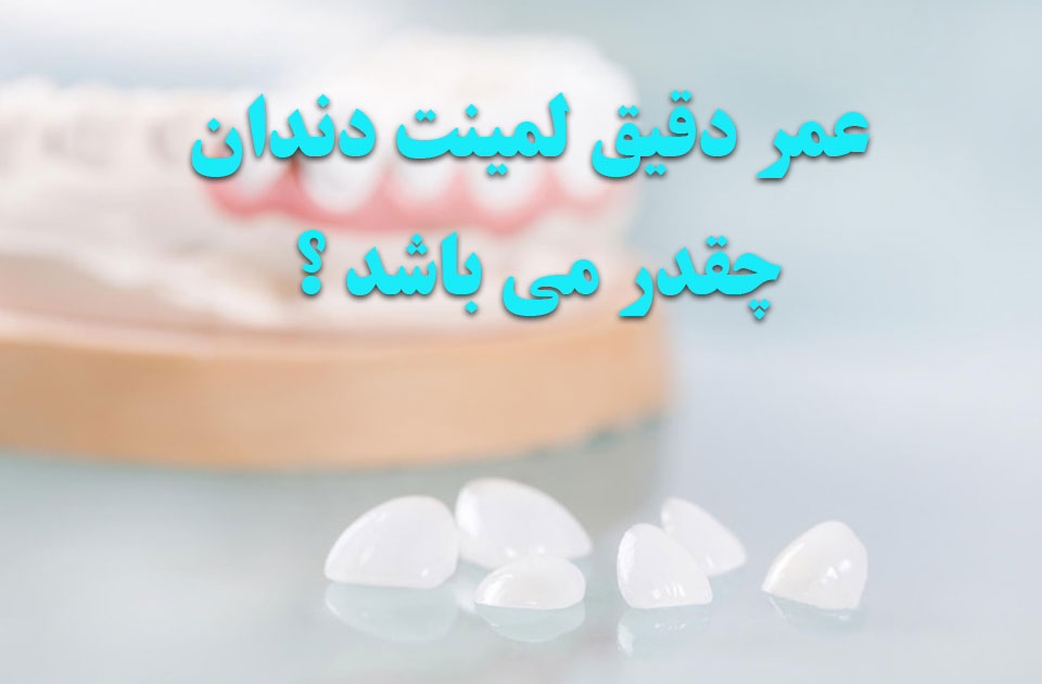 عمر دقیق لمینت دندان چقدر می باشد ؟