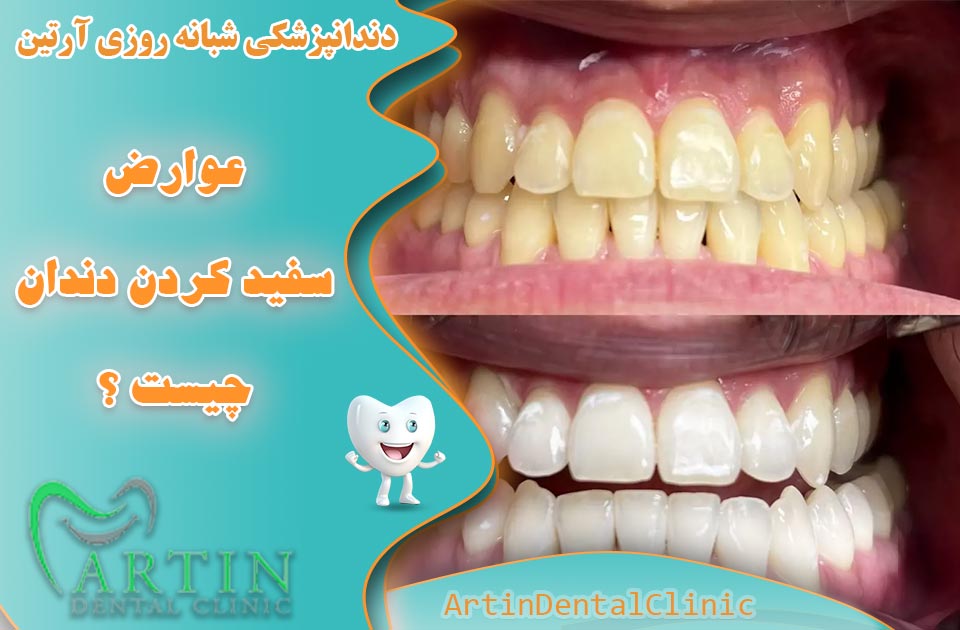 عوارض جانبی سفید کردن دندان چیست ؟