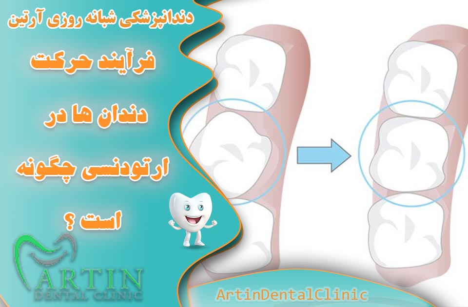 فرایند حرکت دندان ها در ارتودنسی چگونه است ؟