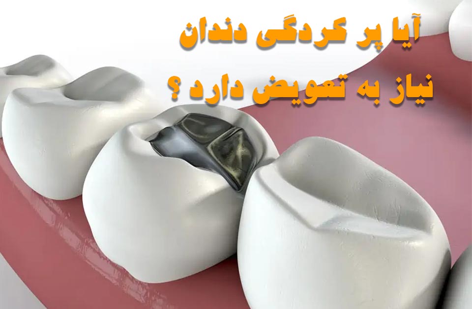 آیا پر کردگی دندان شما نیاز به تعویض دارد ؟