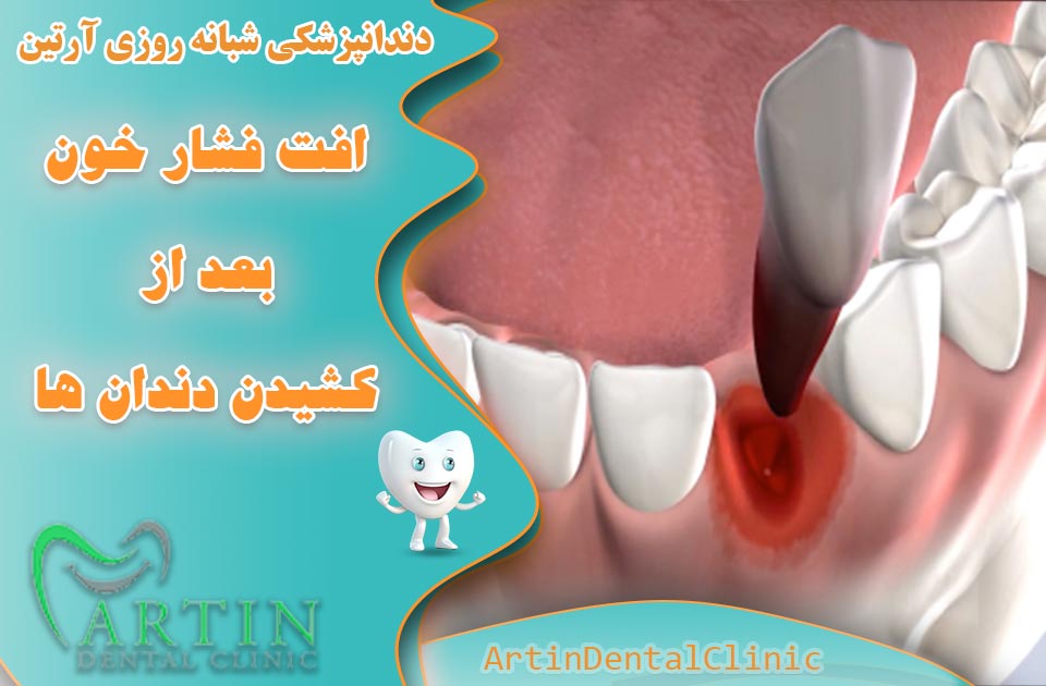 افت فشار خون پس از کشیدن دندان ها