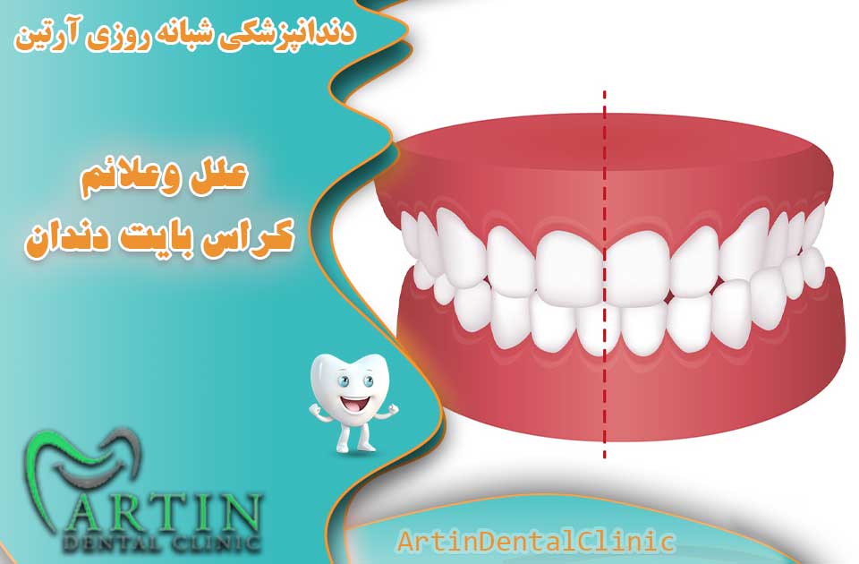 علل وعلائم و گزینه های درمانی کراس بایت دندان