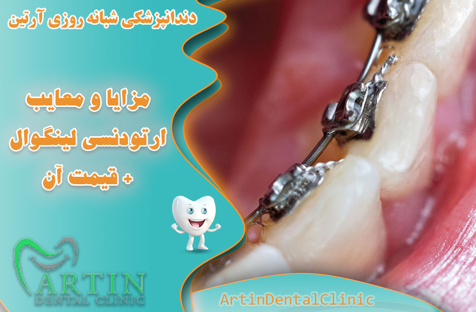 مزایا و معایب ارتودنسی لینگوال +قیمت آن