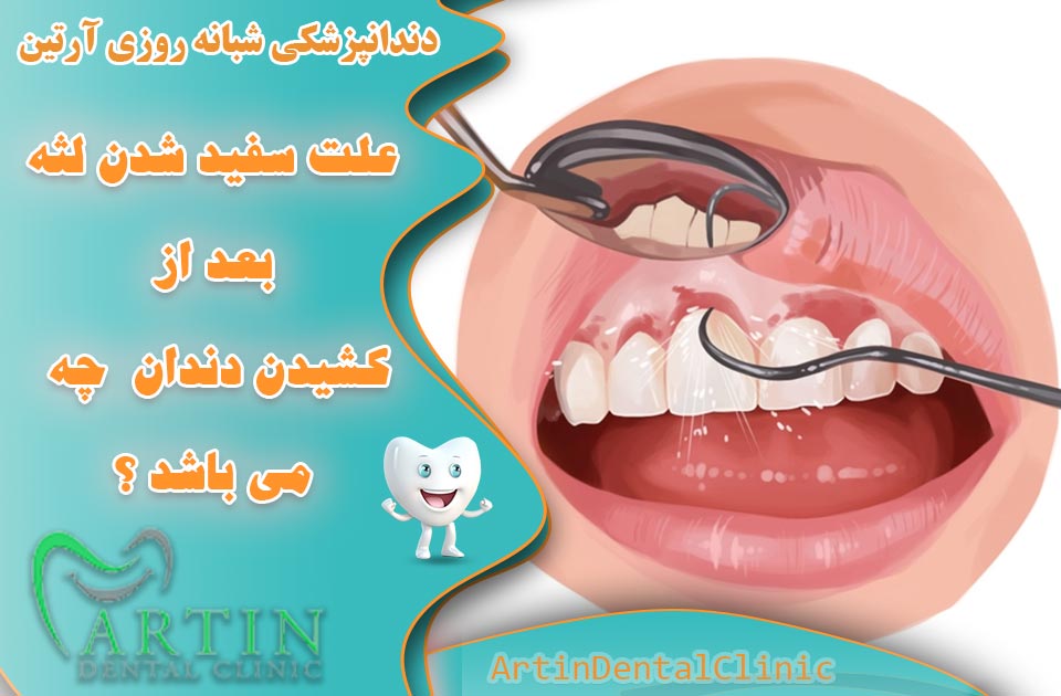 علت سفید شدن لثه بعد از کشیدن دندان چه می باشد ؟
