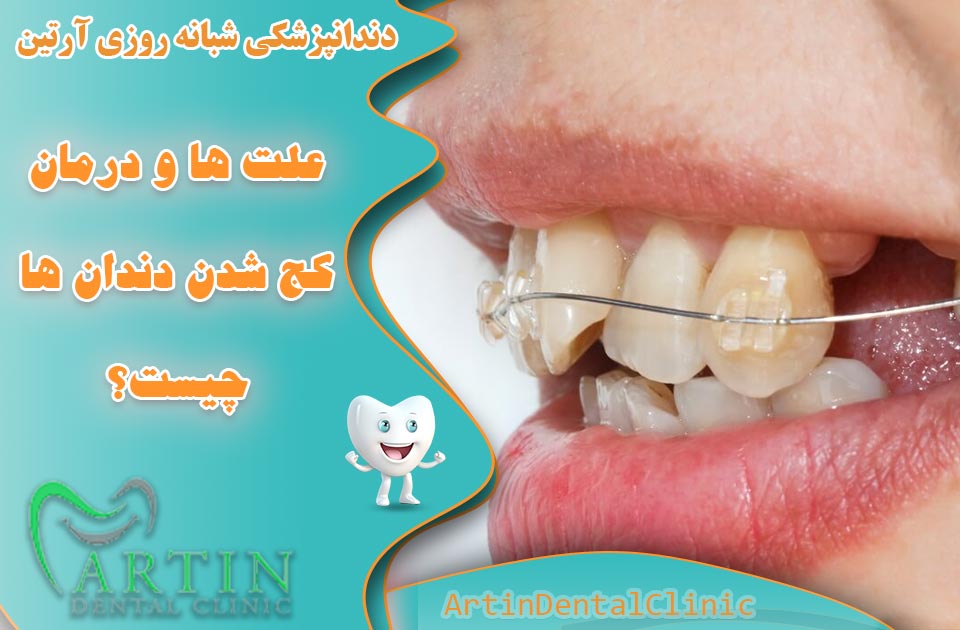 بررسی علت ها و درمان کج شدن دندان ها