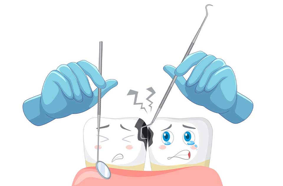 مراحل پر کردن دندان