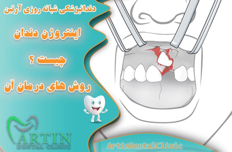اینتروژن دندان چیست؟روش‌ های درمان آن