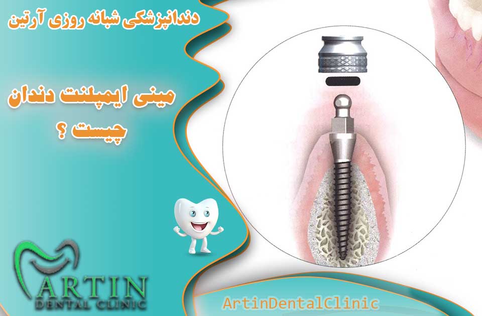 مینی ایمپلنت دندان چیست و چه کاربردی دارد ؟