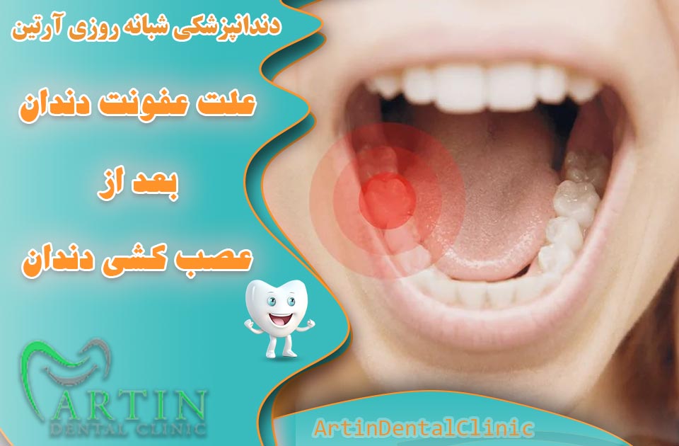 علت ایجاد عفونت دندان پس از عصب‌کشی چیست ؟