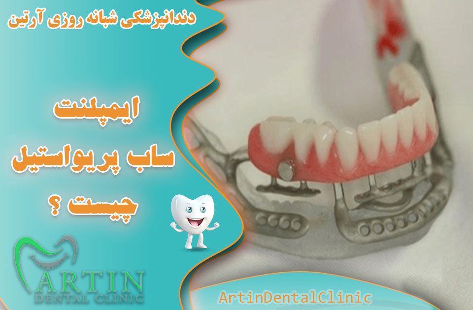 ایمپلنت ساب پریواستیل چیست ؟