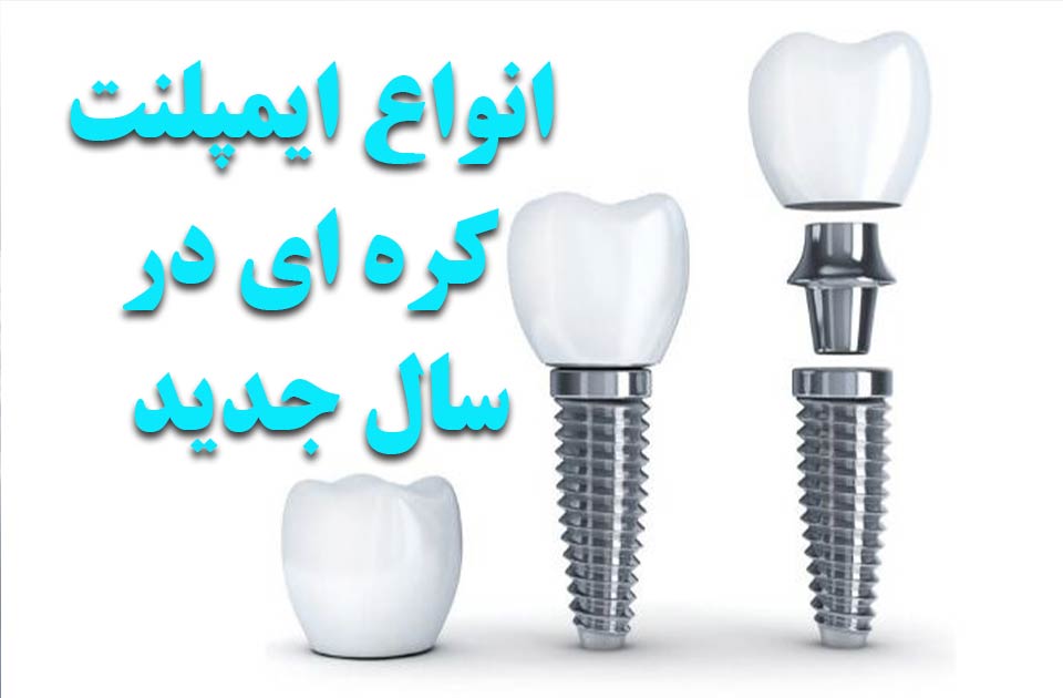 انواع ایمپلنت های کره ای در سال جدید